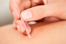 Dry needling